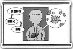 为什么说吉三代是丙肝患者不容错过的良药
